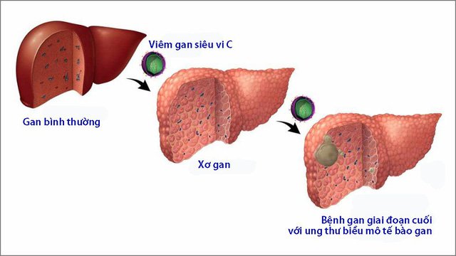 viêm gan c